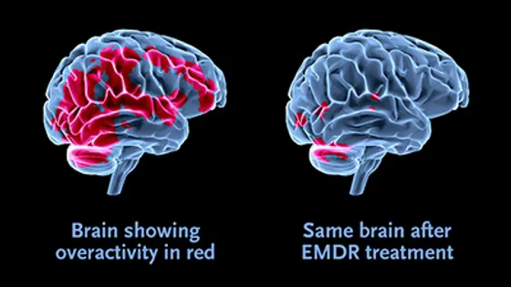 Pic - Diagram of FMRI-scan showing EMDR brain